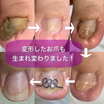 爪甲鉤彎症リセットケア