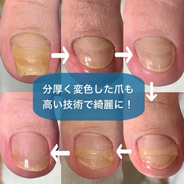 爪甲鉤彎症リセットケア